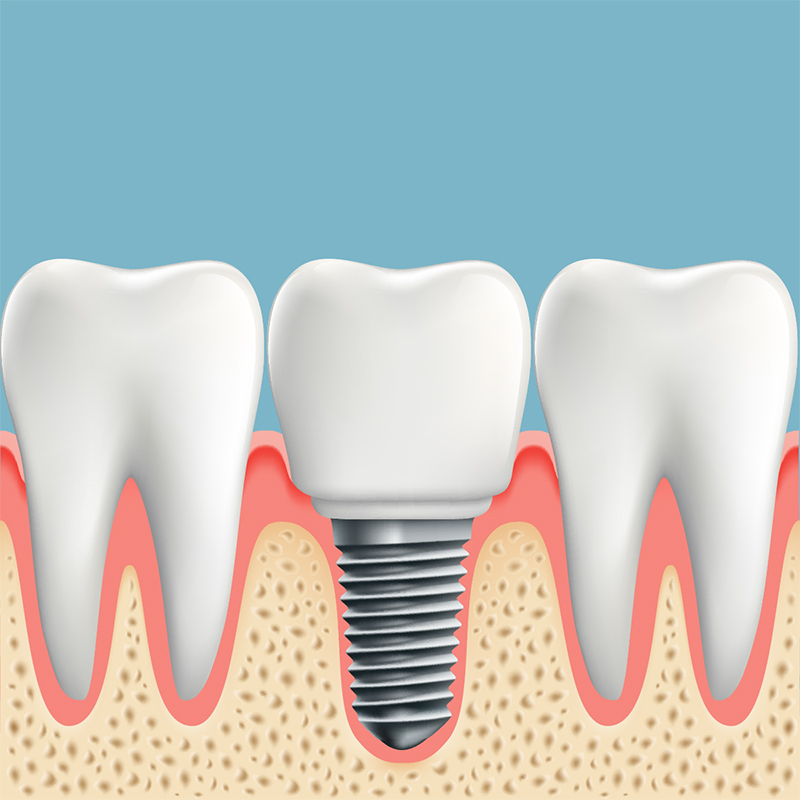 Guia DEFINITIVO de Implantes Dentais