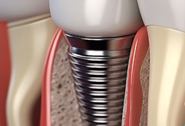 Técnicas de Implantes Dentários