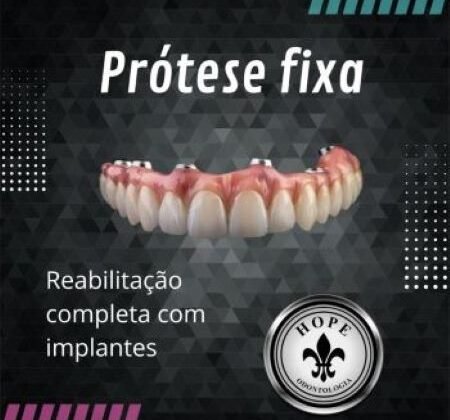 PRÓTESE FIXA SOBRE IMPLANTE