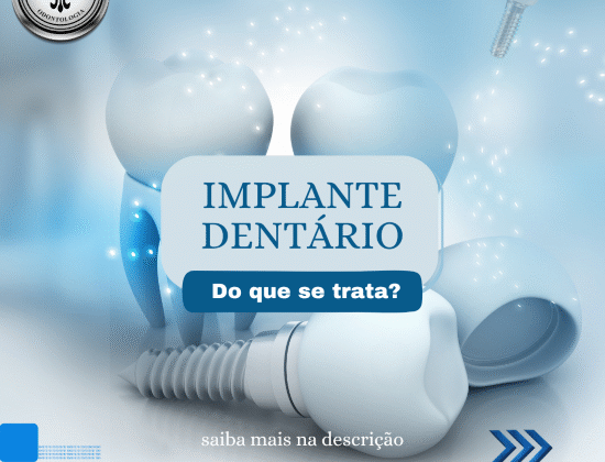 IMPLANTES DENTÁRIOS IMPLANTES DENTÁRIOS