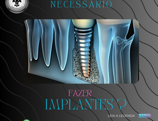 IMPLANTE DENTAL IMPLANTE DENTAL