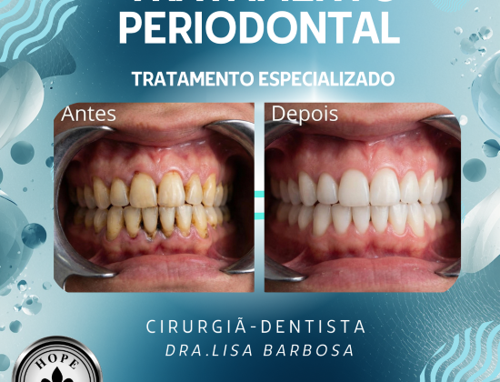 TRATAMENTO PERIODONTAL