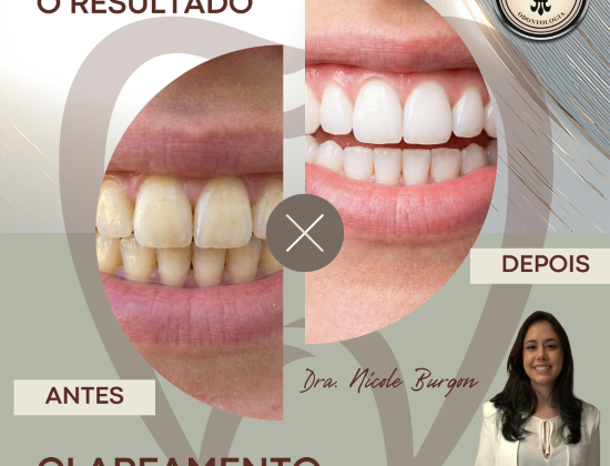 CLAREAMENTO DENTAL