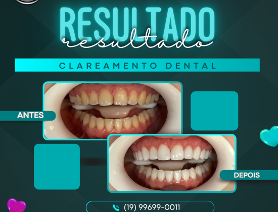 CLAREAMENTO DENTAL