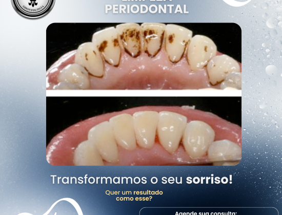 Limpeza Periodontal