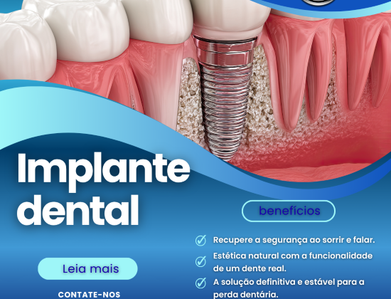IMPLANTE DENTÁRIO IMPLANTE DENTÁRIO