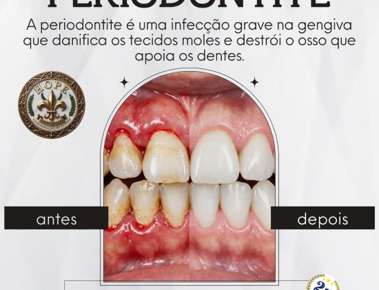 TRATAMENTO PERIODONTAL